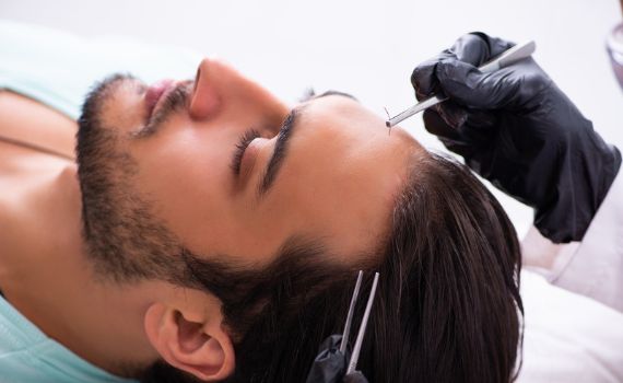 بديل زراعة الشعر